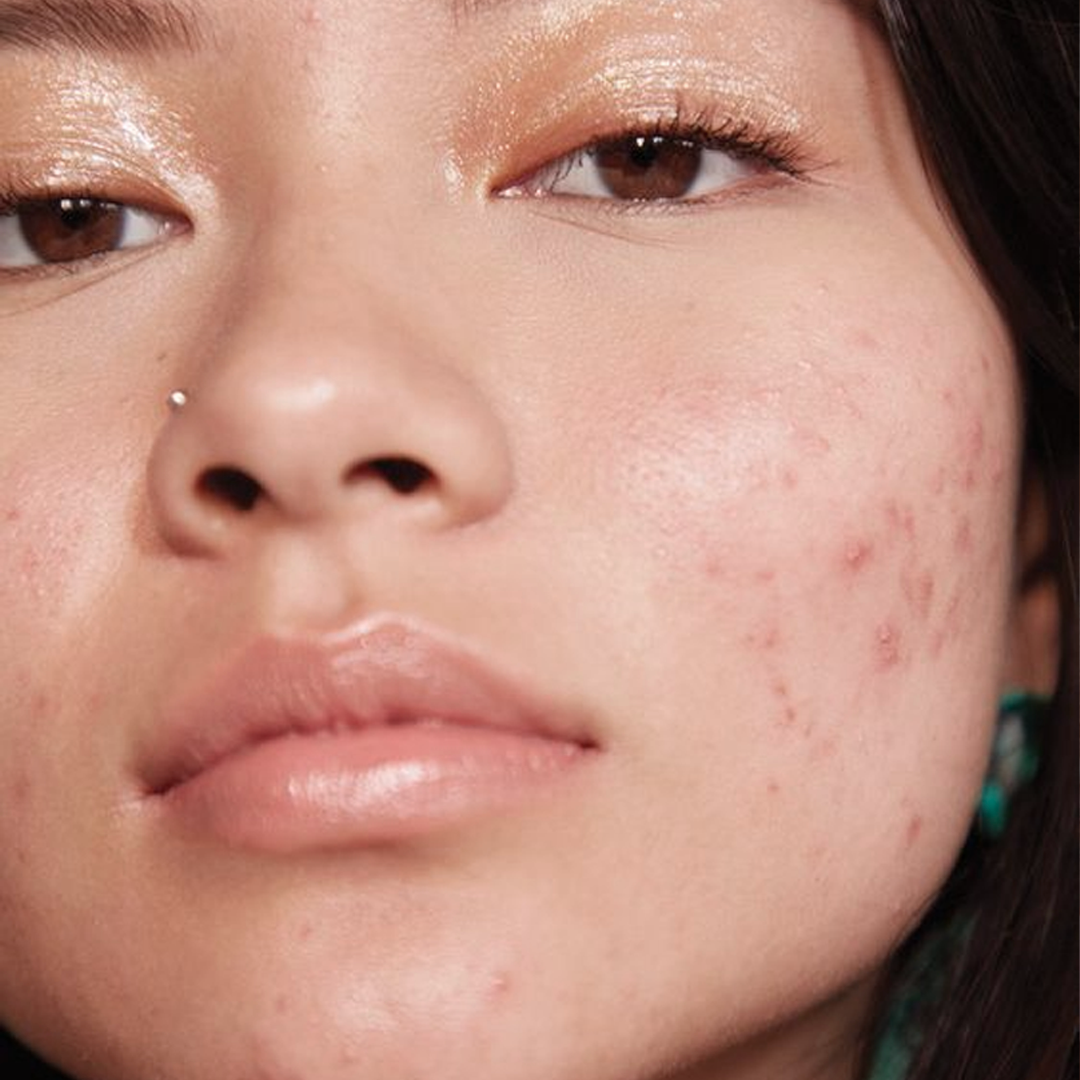 acne_fe005653-ee3e-4871-b691-d115489b553f.png